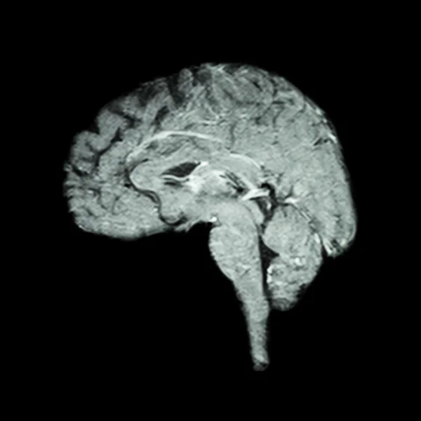 Risonanza magnetica (RM) del cervello (concetto medico, scientifico e sanitario)  ) — Foto Stock