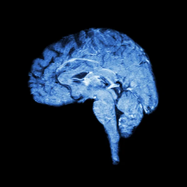 Imágenes por Resonancia Magnética (RM) del cerebro (concepto médico, científico y sanitario)  ) —  Fotos de Stock