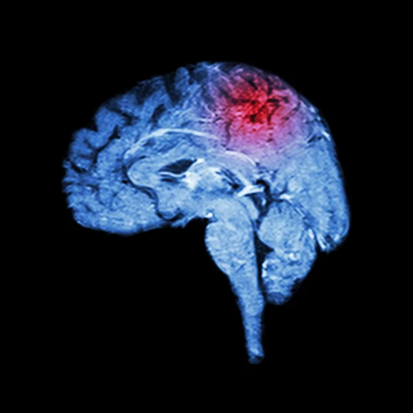 Imágenes por Resonancia Magnética (RM) del cerebro y accidente cerebrovascular (concepto médico, científico y sanitario)  ) — Foto de Stock