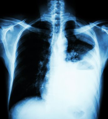 Akciğer kanseri ( göğüs Pa dik film x-ray : akciğer kanseri nedeniyle sol akciğerde plevral efüzyon göstermek ) ( 2 akciğer kanseri türü : Küçük hücreli dışı akciğer kanseri , Küçük hücreli karsinom )