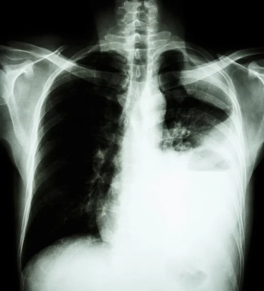 Lung cancer ( film x-ray of chest PA upright : show pleural effusion at left lung due to lung cancer )  ( 2 type of lung cancer : Non-small cell lung cancer , Small cell carcinoma ) — Stock Photo, Image