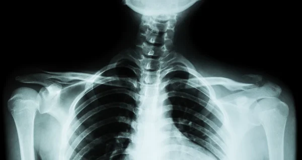 Film x-ray both clavicle AP ( front view ) : show fracture distal left clavicle — Stock Photo, Image