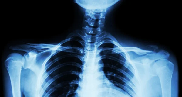 Radiografia por película ambas as clavículas AP (visão frontal): mostrar fratura da clavícula esquerda distal — Fotografia de Stock
