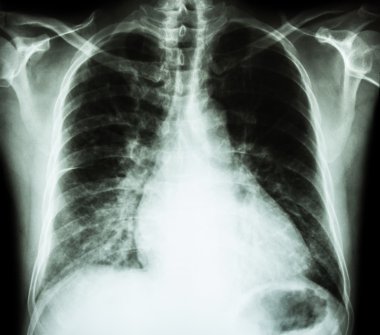 Kalp yetmezliği ( film x-ray göğüs Pa dik : kardiyoomegali ve interstisyel infiltrasyon her iki akciğer göstermek )