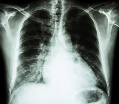 Heart failure  ( film x-ray chest PA upright : show cardiomegaly and interstitial infiltrate both lung ) clipart