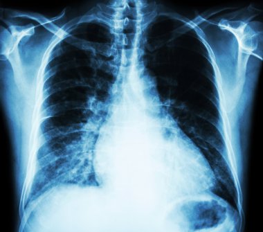 Kalp yetmezliği ( film x-ray göğüs Pa dik : kardiyoomegali ve interstisyel infiltrasyon her iki akciğer göstermek )