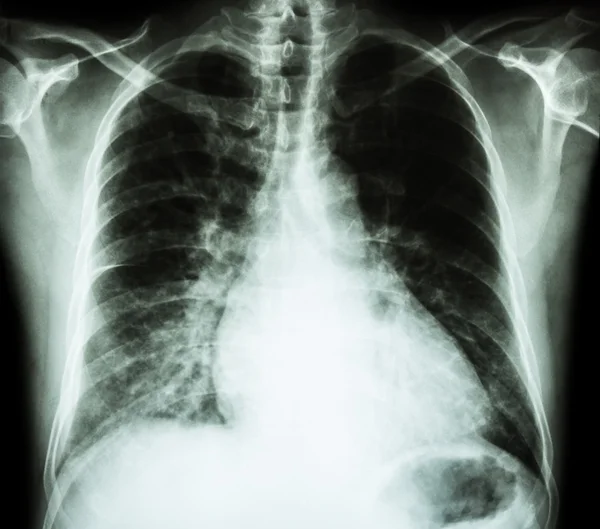 Insuficiencia cardíaca (radiografía de la película de tórax PA vertical: mostrar cardiomegalia e infiltrado intersticial ambos pulmones  ) — Foto de Stock