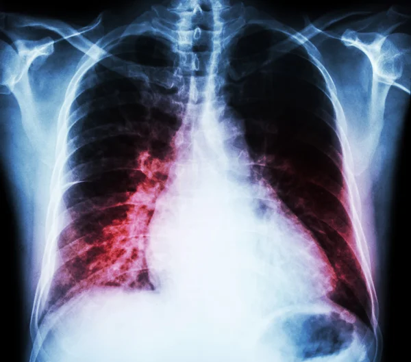 Insuficiencia cardíaca (radiografía de la película de tórax PA vertical: mostrar cardiomegalia e infiltrado intersticial ambos pulmones  ) — Foto de Stock