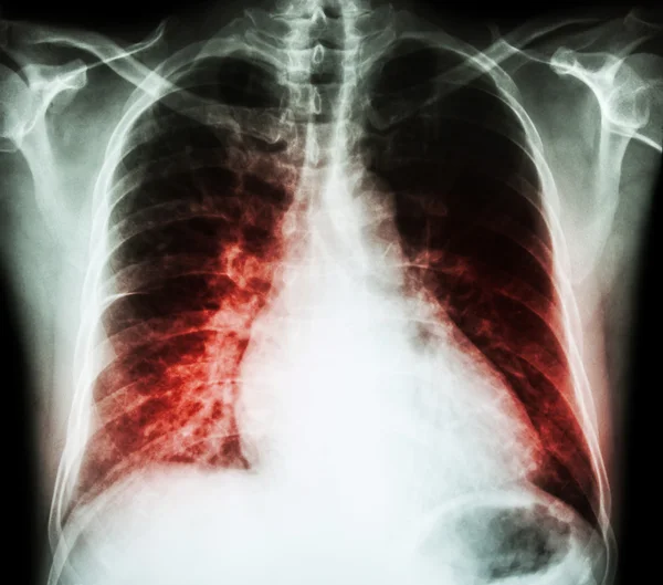 Insuficiencia cardíaca (radiografía de la película de tórax PA vertical: mostrar cardiomegalia e infiltrado intersticial ambos pulmones  ) —  Fotos de Stock