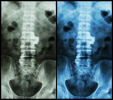 Spondilosis ( film x-Ray lumbo - sakral omurga : L2-3 de spondiloz göstermek )