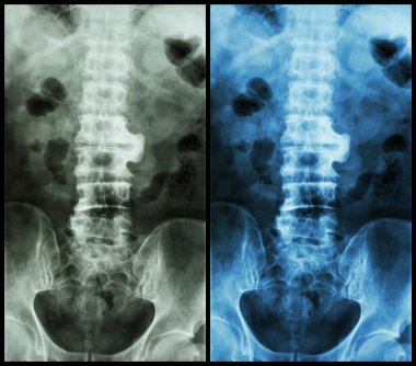 Spondylosis ( film x-ray lumbo - sacral spine : show spondylosis at L2-3 ) clipart