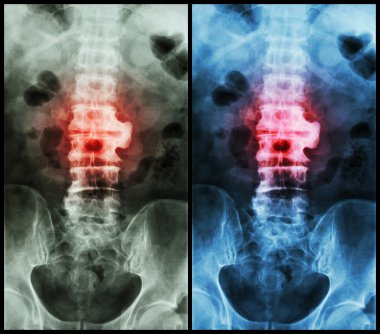 Spondilosis ( film x-Ray lumbo - sakral omurga : L2-3 de spondiloz göstermek )