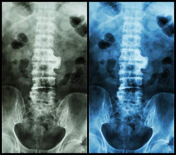 Spondylosis ( film x-ray lumbo - sacral spine : show spondylosis at L2-3 )