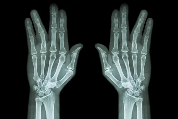 Fracture shaft of proximal phalange of ring finger ( film x-ray both hand AP ) — Stock Photo, Image