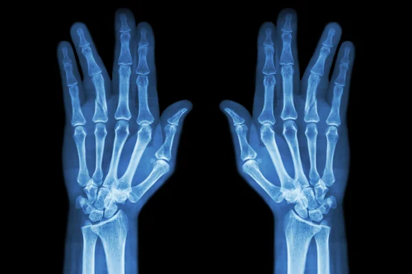 Перелом вала проксимальной фаланги безымянного пальца (рентген пленки обеих рук AP  ) — стоковое фото