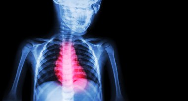 İskemik Kalp Hastalığı , Miyokard Enfarktüsü ( Mi ) ( Sağ tarafta kalp hastalığı ve boş alan ile insan Film x-Ray vücut ) ( Kardiyopulmoner resuscitate ve Kardiyovasküler kavram )