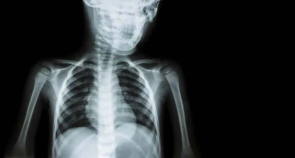 Film x-ray lichaam van het kind en blanco gebied aan de rechterkant (medische achtergrond ) — Stockfoto