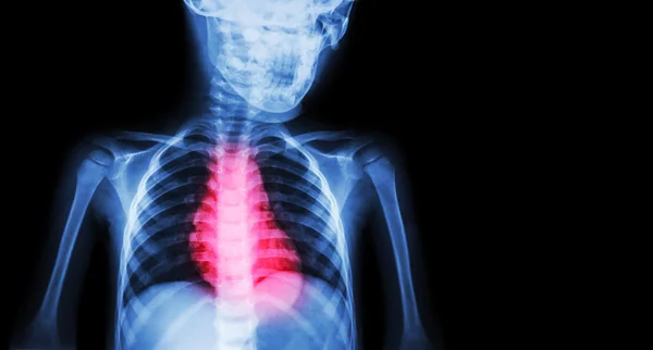 Ischemic Heart Disease , Myocardial Infarction ( MI ) ( Film x-ray body of human with heart disease and blank area at right side ) ( Cardiopulmonary resuscitate and Cardiovascular concept ) — Stock Photo, Image