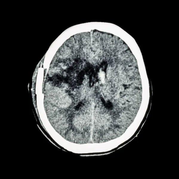 КТ-сканування мозку: показати старий правий базальний крововилив ганглії з набряком мозку (статус пост-кранотомії) (геморагічний інсульт  ) — стокове фото