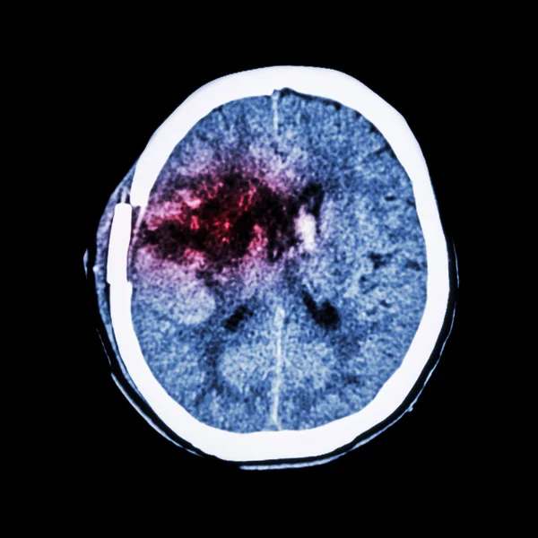 CT scan du cerveau : montrer une hémorragie des ganglions basaux droit avec œdème cérébral (état post-craniotomie) (AVC hémorragique  ) — Photo