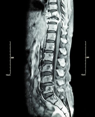 Omurga metastaz (torasik omurga için yayılmış kanser) (MRI göğüs ve bel omurga: torasik omurga metastaz göstermek ve spinal kord (miyelopati) sıkıştırmak) (sagittal düzlem )