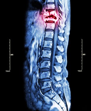 Omurga metastaz (torasik omurga için yayılmış kanser) (MRI göğüs ve bel omurga: torasik omurga metastaz göstermek ve spinal kord (miyelopati) sıkıştırmak) (sagittal düzlem )