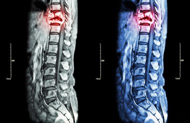 Omurga metastaz (torasik omurga için yayılmış kanser) (MRI göğüs ve bel omurga: torasik omurga metastaz göstermek ve spinal kord (miyelopati) sıkıştırmak) (sagittal düzlem )