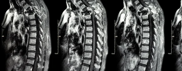 Omurga metastazı ( torasik omurgaya yayılan kanser ) ( Servikal ve torasik omurganın MRI 'sı : torasik omurga metastazı gösterin ve omuriliği sıkıştırın ( Miyelopati ) ( sagital düzlem ) — Stok fotoğraf