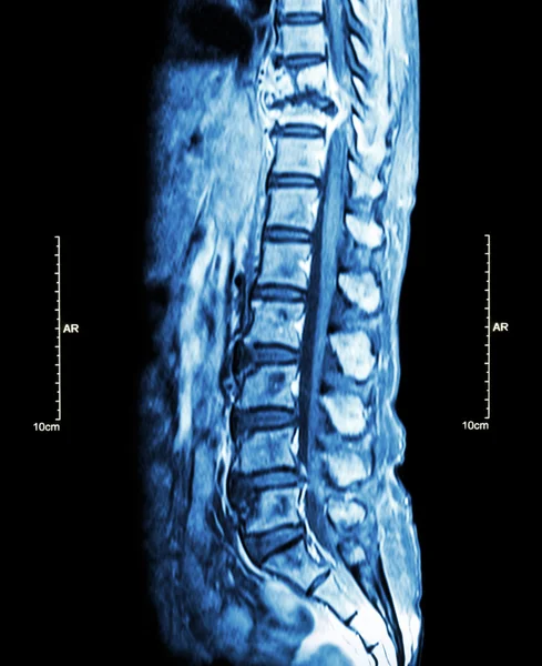 Métastases de la colonne vertébrale (propagation du cancer à la colonne vertébrale thoracique) (IRM de la colonne vertébrale thoracique et lombaire : métastases de la colonne vertébrale thoracique et compression de la moelle épinière (myélopathie)) (plan sagittal  ) — Photo