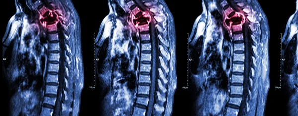 Métastases de la colonne vertébrale (propagation du cancer à la colonne vertébrale thoracique) (IRM de la colonne cervicale et thoracique : métastases de la colonne vertébrale thoracique et compression de la moelle épinière (myélopathie)) (plan sagittal  ) — Photo