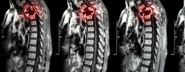 脊柱転移(癌は胸部脊椎に広がる) ( 子宮頸部および胸部脊椎のMri : 胸部脊椎転移および圧縮脊髄を示す (骨髄症) ( 矢状面 ) ) — ストック写真