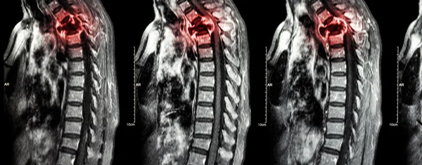 Metástase da coluna vertebral (disseminação do cancro para a coluna torácica) (RM da coluna cervical e torácica: mostrar metástase da coluna torácica e comprimir a medula espinhal (mielopatia)) (plano sagital  ) — Fotografia de Stock