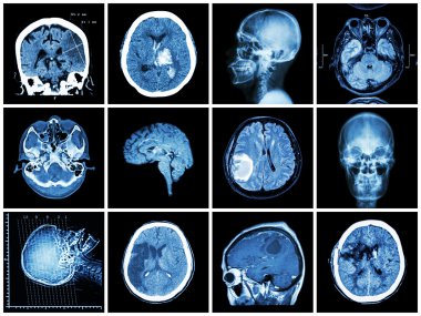 Beyin hastalığı nın toplanması ( Beyin detografisi ve Mri : serebral infarkt , intraserebral kanama , beyin tümörü , bazal ganglia kanaması ( durum sonrası kraniyotomi ) ( sağlık kavramı )