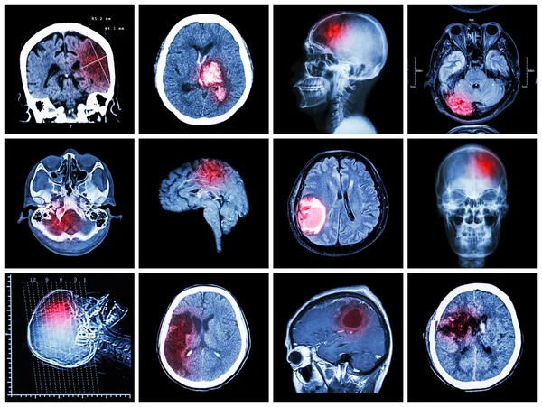 Beyin hastalığı nın toplanması ( Beyin detografisi ve Mri : serebral infarkt , intraserebral kanama , beyin tümörü , bazal ganglia kanaması ( durum sonrası kraniyotomi ) ( sağlık kavramı )