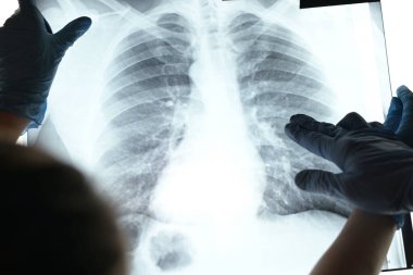 Tıbbi eldiven giyen doktorlar ciğerlerin röntgenini çeker. Zatürree başlangıcı olan bir hastanın florografisi.