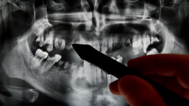 Рентген с плохими зубами — стоковое видео