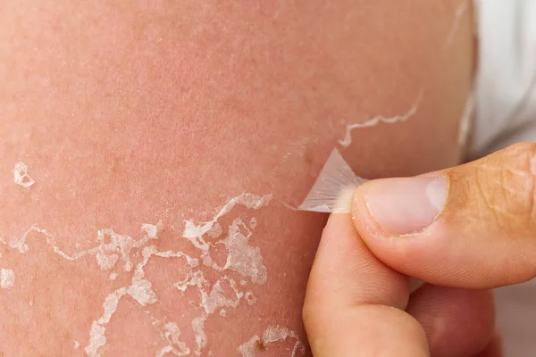 Descamación de la piel después de quemada por la luz solar. no usar protector solar — Foto de Stock