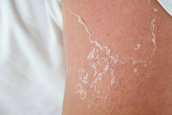 Fjällning av huden efter att ha bränts av solljus. utan solskyddsmedel — Stockfoto