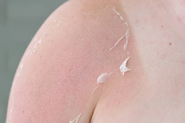 Pele queimada no sol em um corpo de homem. Cuidados com a pele e conceito de proteção UV — Fotografia de Stock