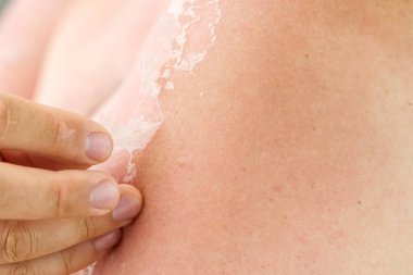 Bir adamın vücudunda güneş yanığı. Cilt bakımı ve UV koruma kavramı