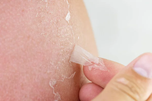 Poparzona skóra na ciele mężczyzny. Koncepcja pielęgnacji skóry i ochrony przed promieniowaniem UV — Zdjęcie stockowe