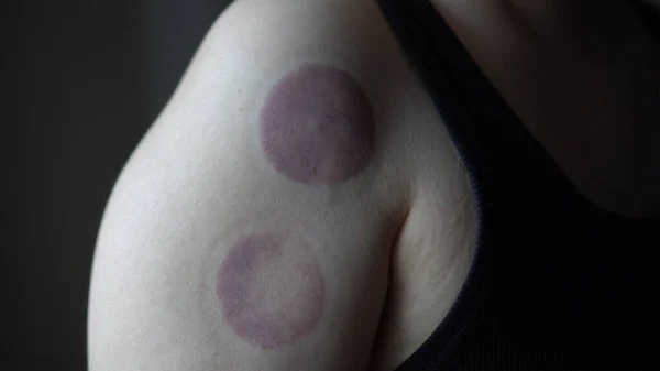 Marcas Hematomas Ventosas Terapia Alternativa Para Circulação Sanguínea Alívio — Fotografia de Stock