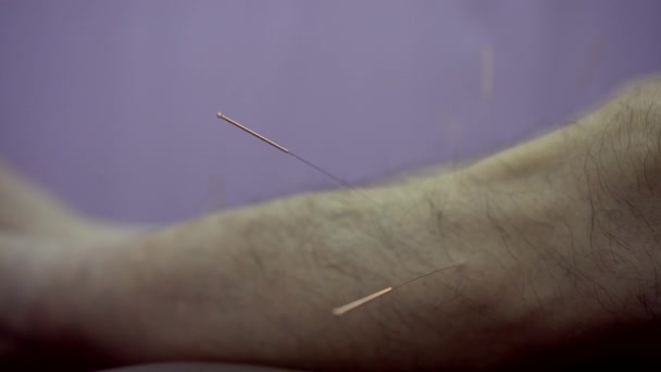 Aiguilles Chinoises Acupuncture Traitement Alternatif Sur Réhabilitation Des Jambes Homme — Video