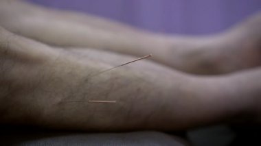 Çin alternatif tedavi akupunktur iğneleri Asyalı erkek bacakları rehabilitasyonunda, vücudun Yang akışını ayarlamak için.