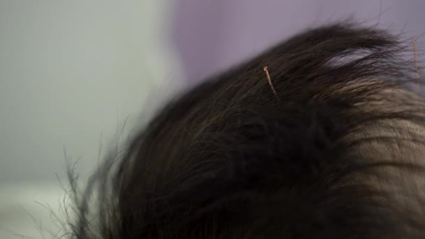 Čínská Alternativní Léčba Akupunkturní Jehly Asijské Muž Vlasy Rehabilitace Upravit — Stock video
