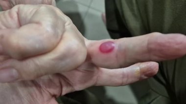 Parmağın kenarındaki kan kabarcığının yakın plan görüntüsü, kabarık, kırmızımsı, derinin altında sıvı dolu bir şişkinliği gösteriyor.