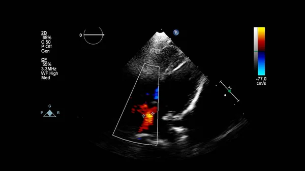 Imagem Coração Durante Ultrassom Transesofágico Com Modo Doppler — Fotografia de Stock