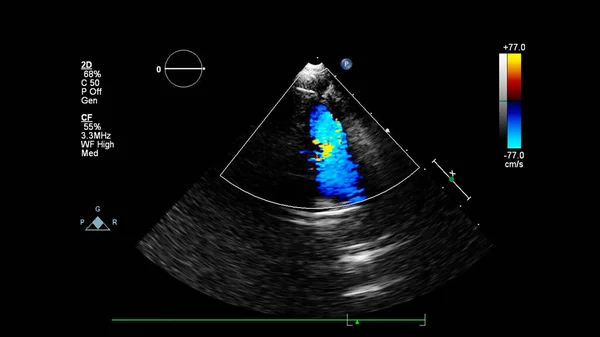 Bild Des Herzens Beim Transesophagealen Ultraschall Mit Doppler Modus — Stockfoto