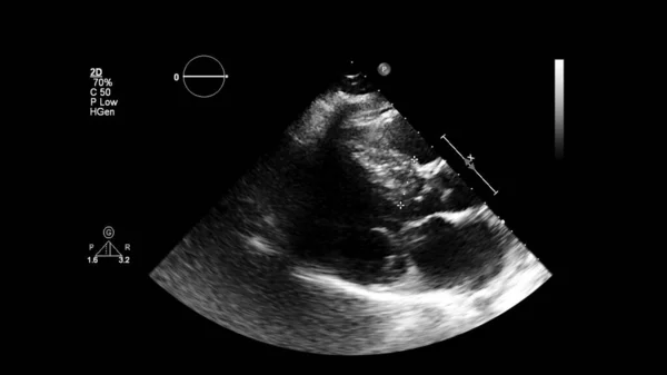 Image of the heart in gray-scale mode during transesophageal ultrasound.