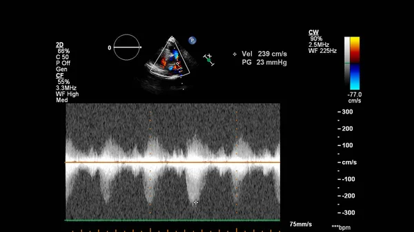Obraz Serca Podczas Przełyku Usg Trybem Dopplera — Zdjęcie stockowe